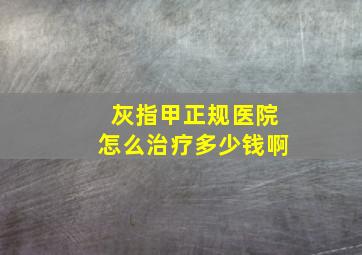 灰指甲正规医院怎么治疗多少钱啊