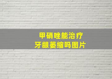 甲硝唑能治疗牙龈萎缩吗图片